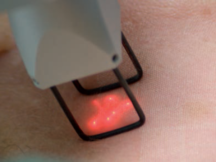 công nghệ laser smarxide dot