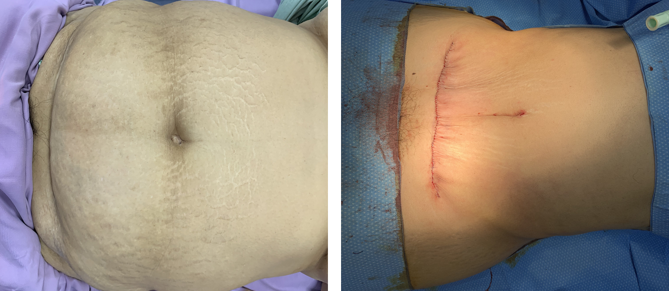 phan-giai-mo-smartlipo1