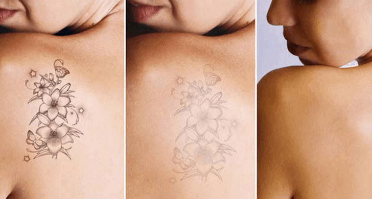 xóa hình xăm không mong muốn