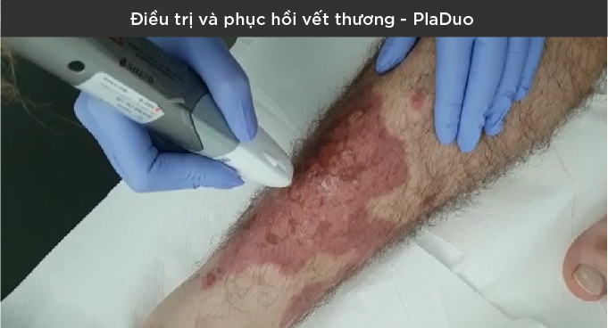 plasma-lanh-phuc-hoi-va-dieu-tri-vet-thuong