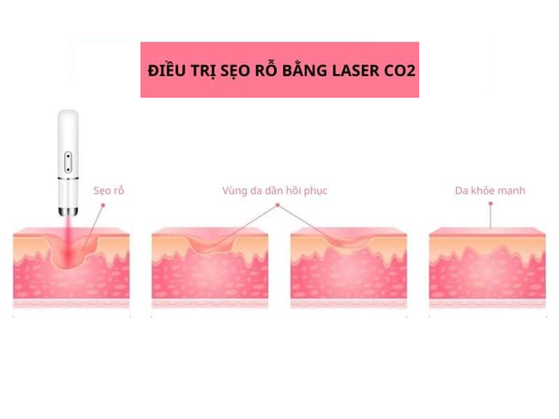 trị sẹo rỗ bằng laser co2