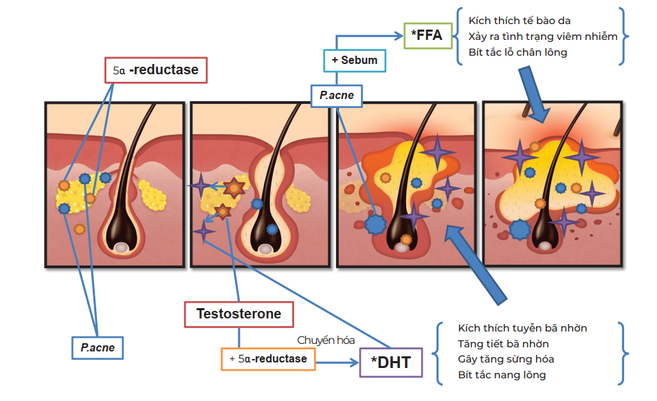 nguyen-nhan-goc-re-hinh-thanh-mun